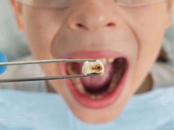 Best Emergency Treatment for Dental Infections or Abscesses in Springfield, VA